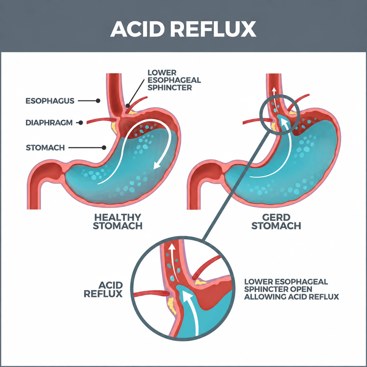 Diagram comparing a healthy anti-reflux valve with gastro-oesophageal reflux