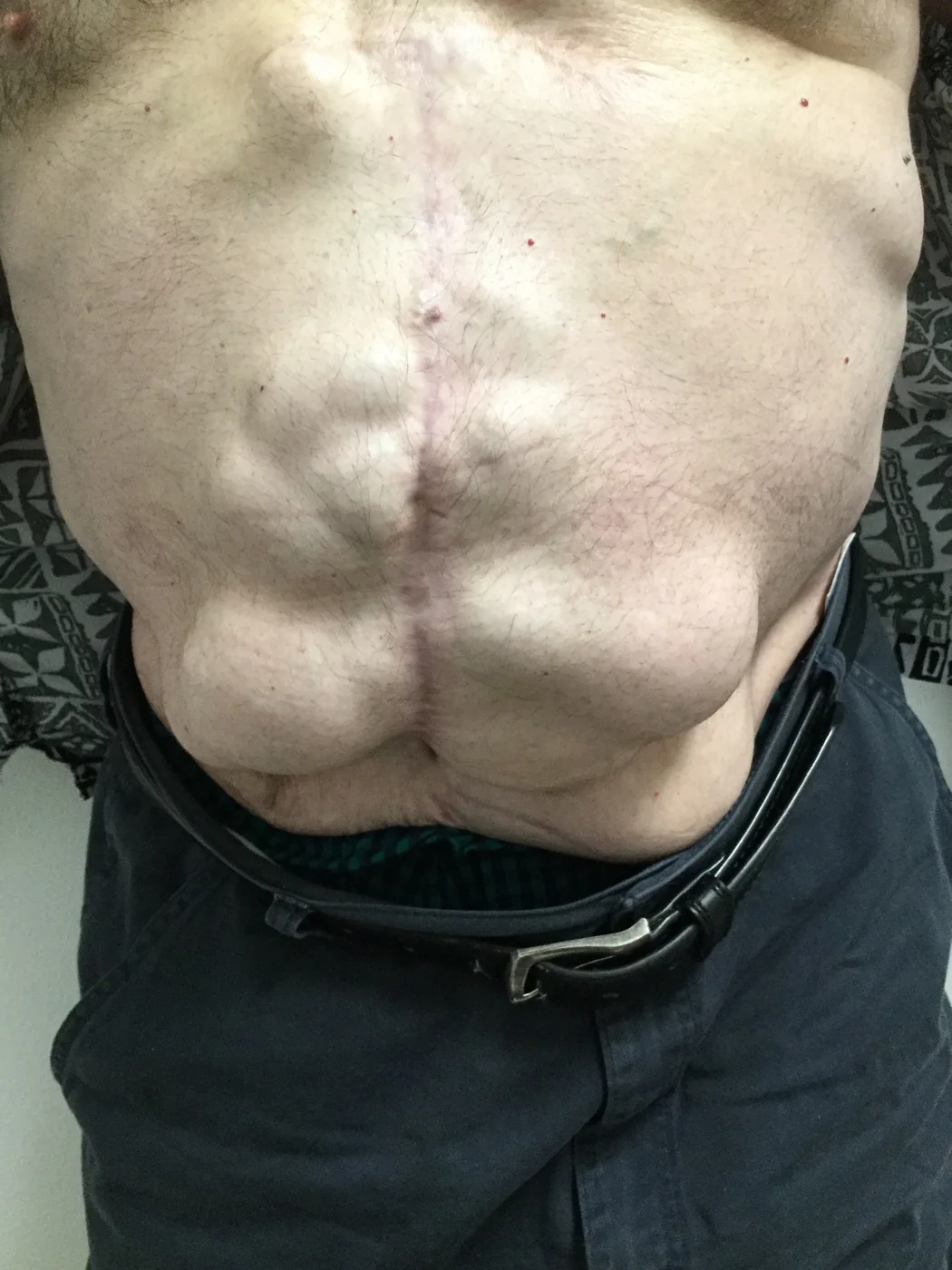 Photograph showing a large complex abdominal-wall hernia with previous scars