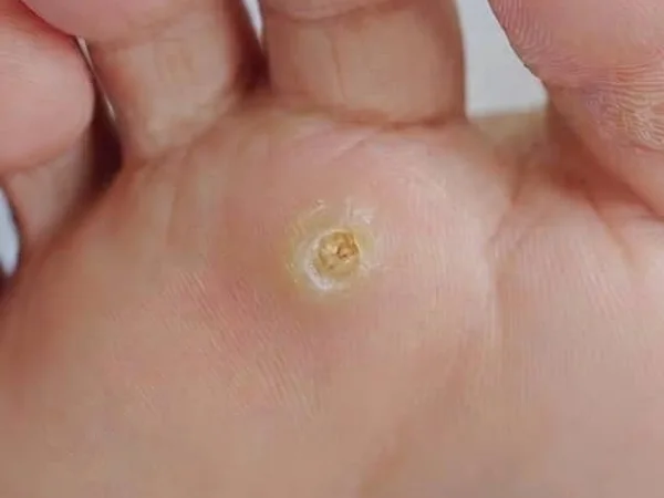 Corn on the sole of the foot