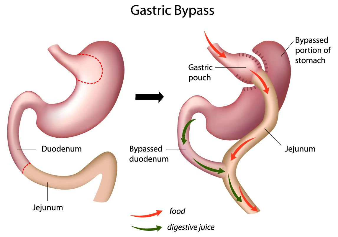 Diagram showing a small gastric pouch and rerouted bowel after Roux-en-Y gastric bypass