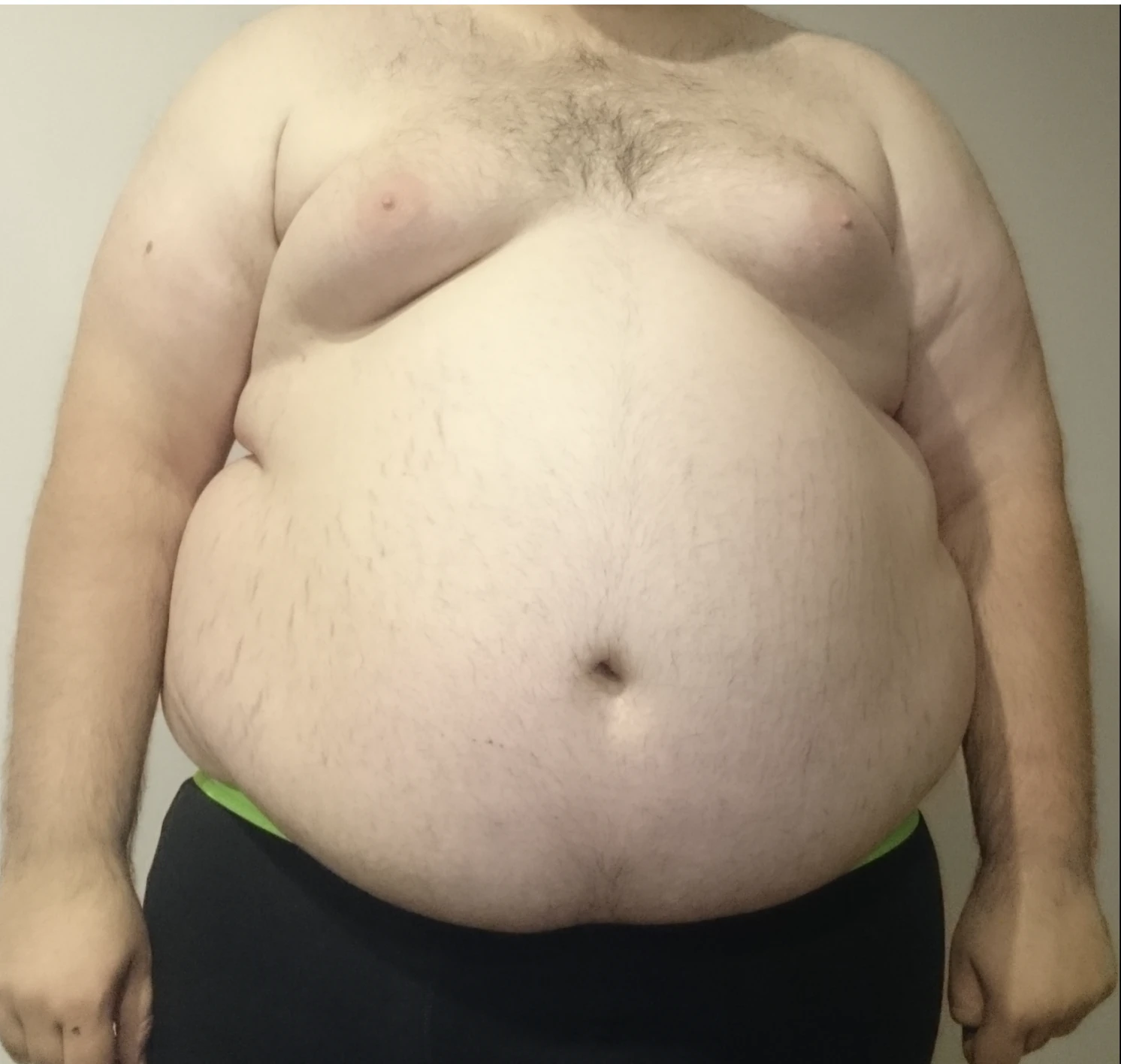 Clinical photograph showing central obesity in an adult
