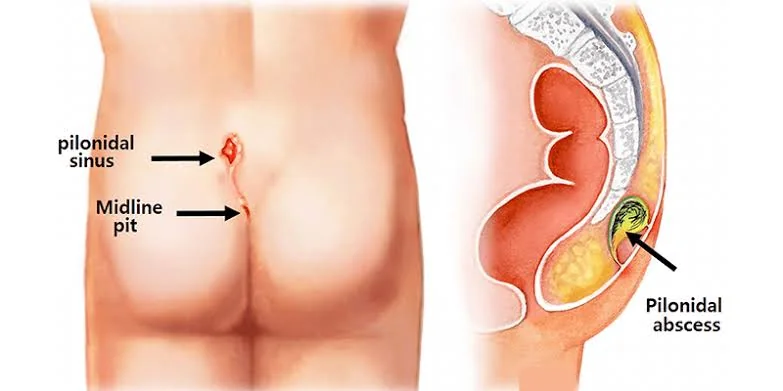 Diagram showing a pilonidal sinus and abscess in the buttock cleft