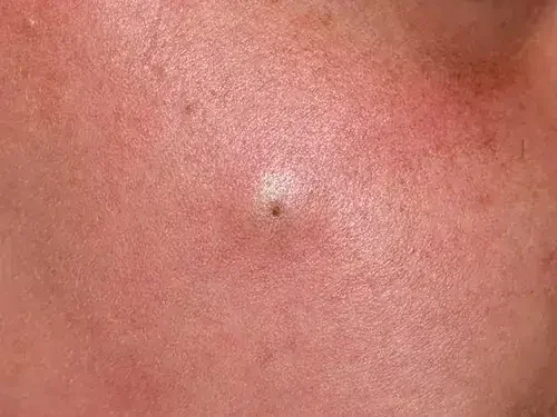 Sebaceous cyst on the skin with a small central dark dot