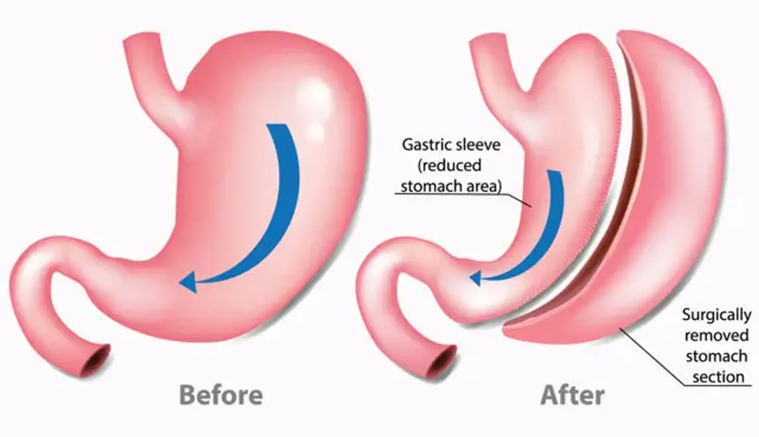 Diagram comparing the stomach before and after sleeve gastrectomy